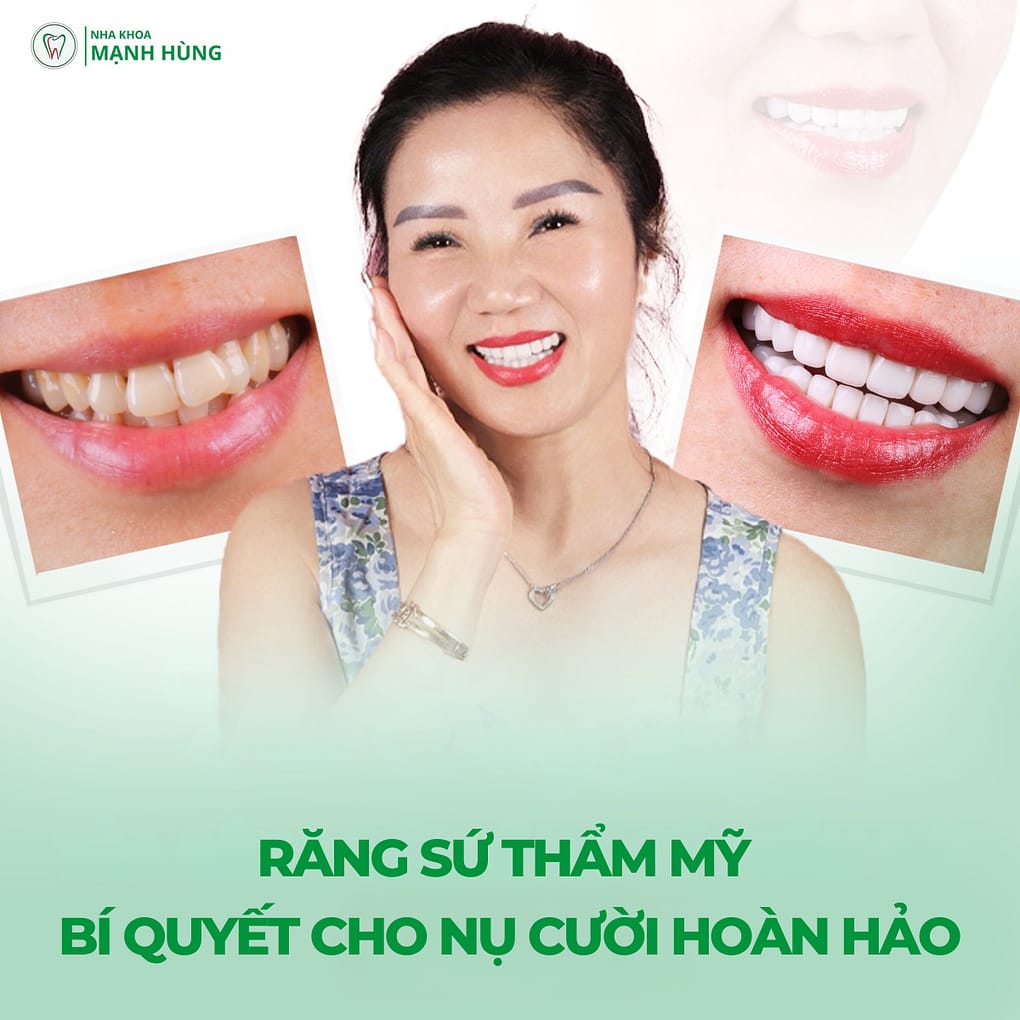 Răng sứ thẩm mỹ bí quyết cho nụ cười hoàn hảo tại Nha khoa Mạnh Hùng