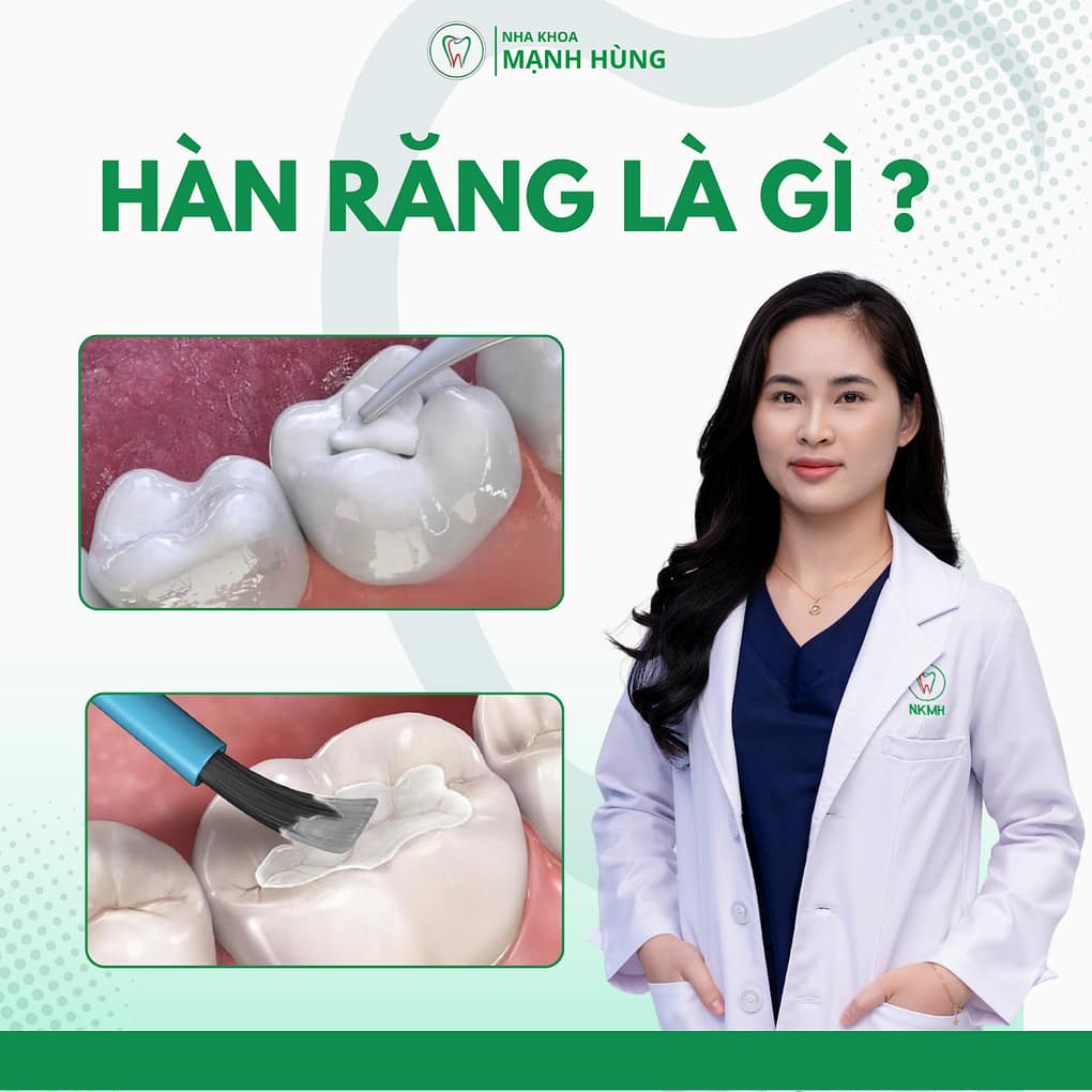 Hàn răng là gì?