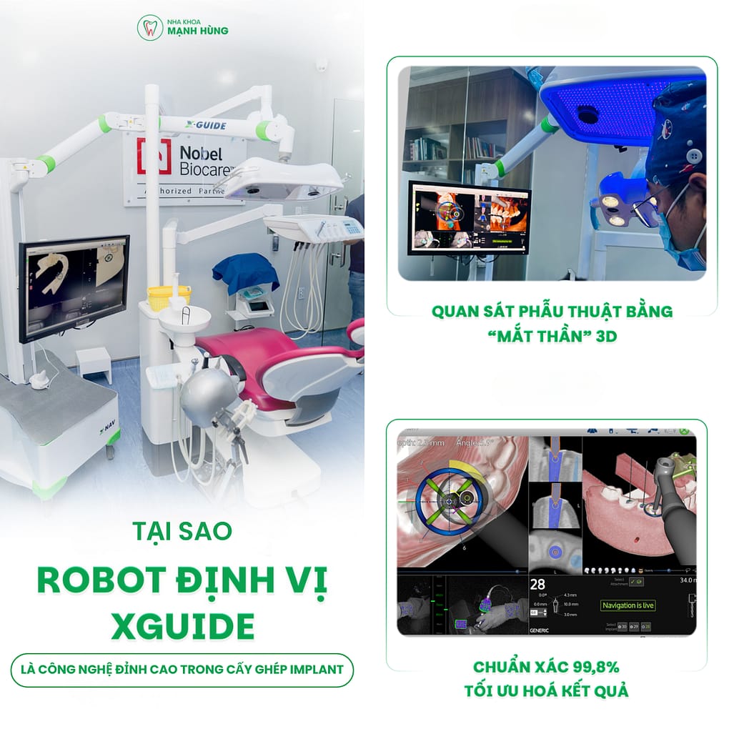 Tại Sao Robot Định Vị X - GUIDE Là Công Nghệ Đỉnh Cao Trong Cấy Ghép Implant?