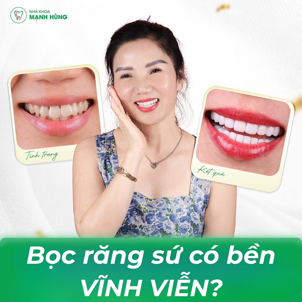 Bọc Răng sứ có bền không? Sự thật bạn cần biết