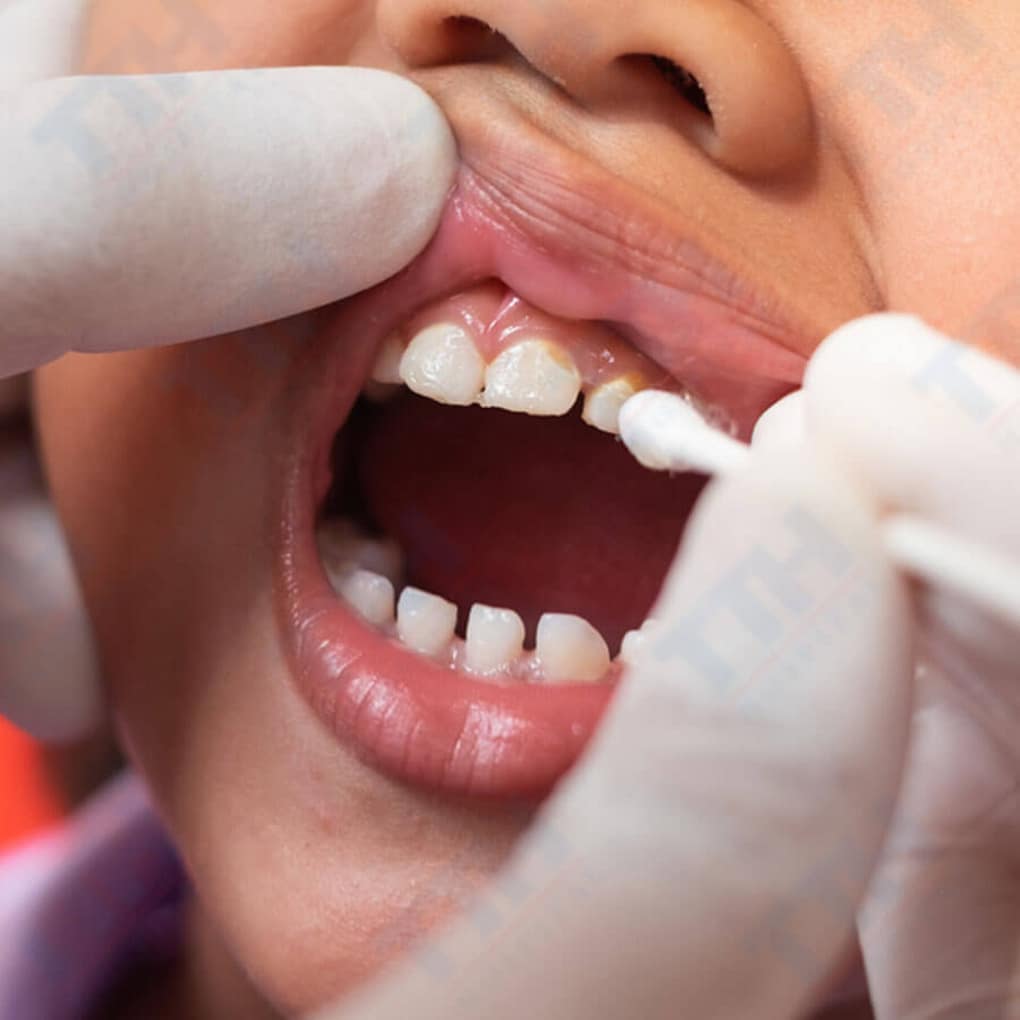 Fluoride Cho Trẻ Là Gì? Lợi Ích Và Tần Suất Nên Sử Dụng