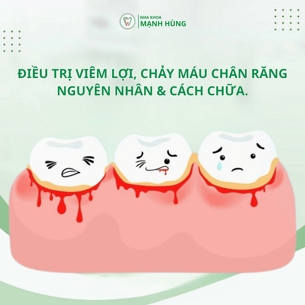 Điều trị viêm lợi, chảy máu chân răng: Nguyên nhân & cách chữa.