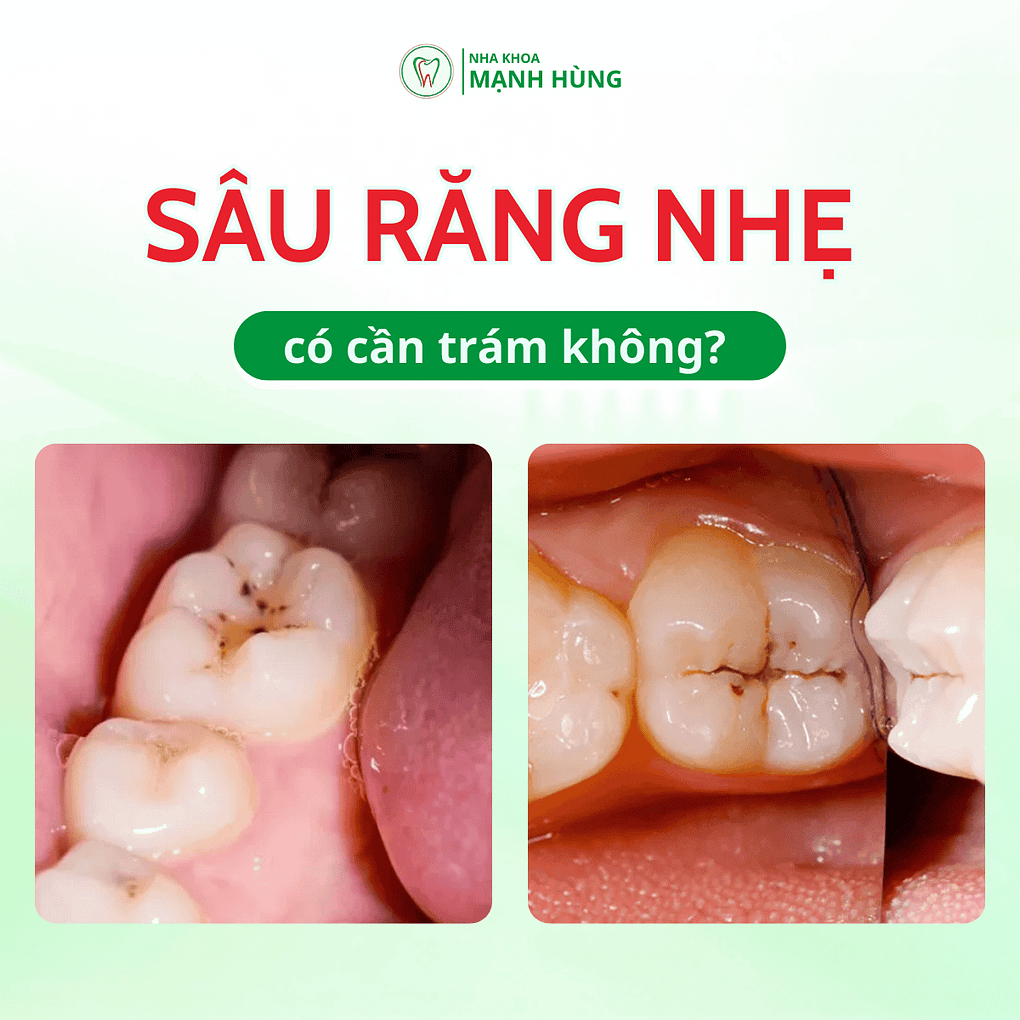 Sâu răng nhẹ có cần trám không?