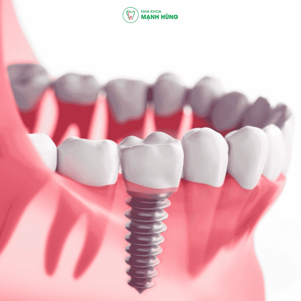 Cấy ghép Implant mất bao lâu để lành và ăn nhai bình thường?