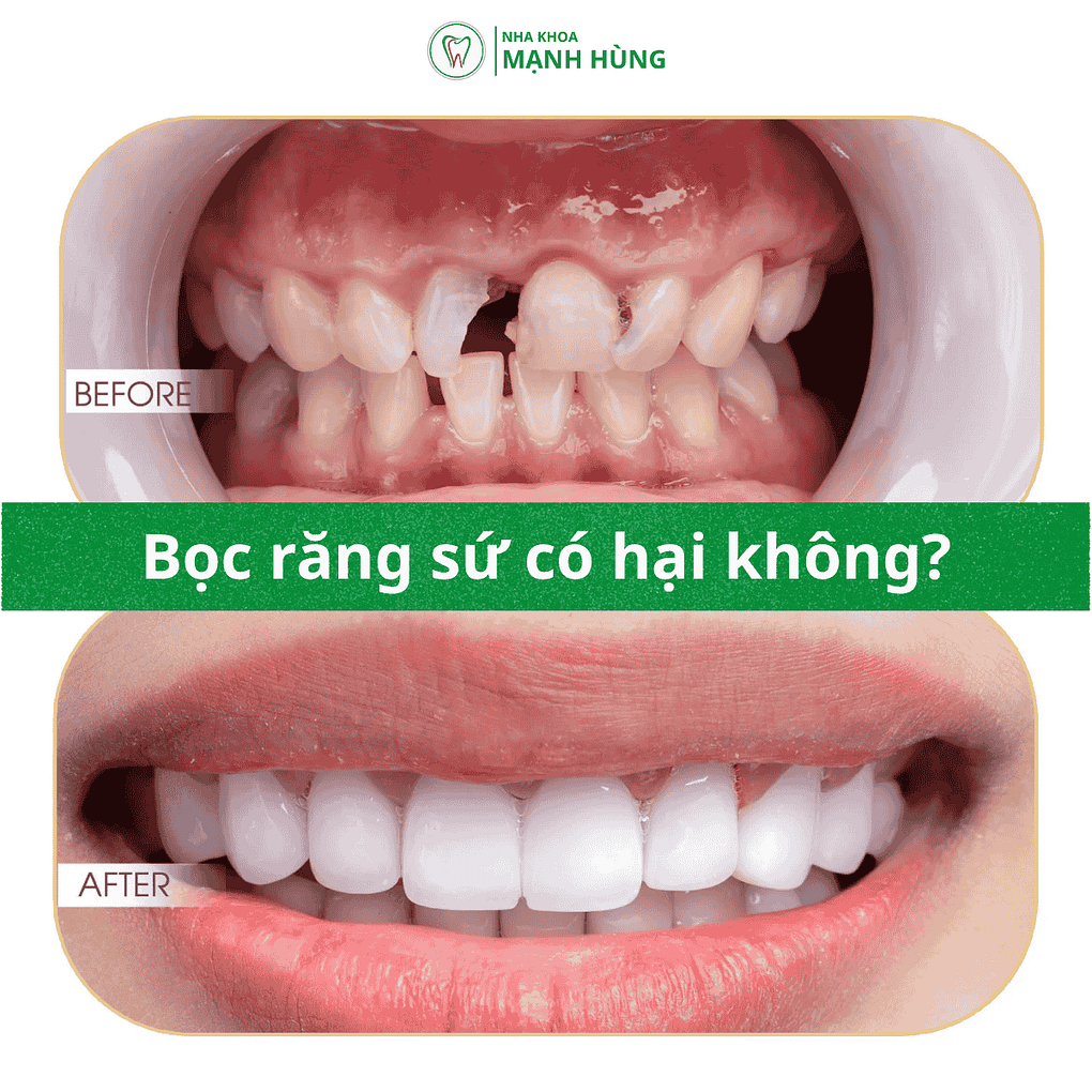 Bọc răng sứ có hại không? Sự thật bạn cần biết trước khi làm.