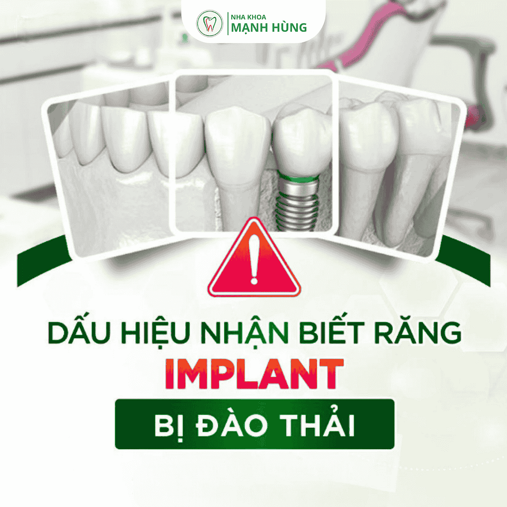 Những dấu hiệu cảnh báo Implant bị đào thải và cách xử lý
