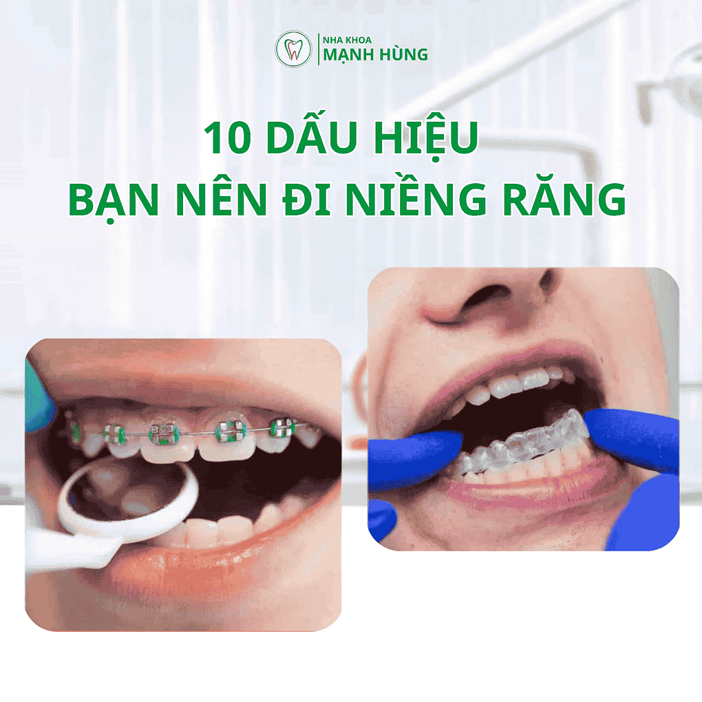 10 dấu hiệu bạn nên đi niềng răng