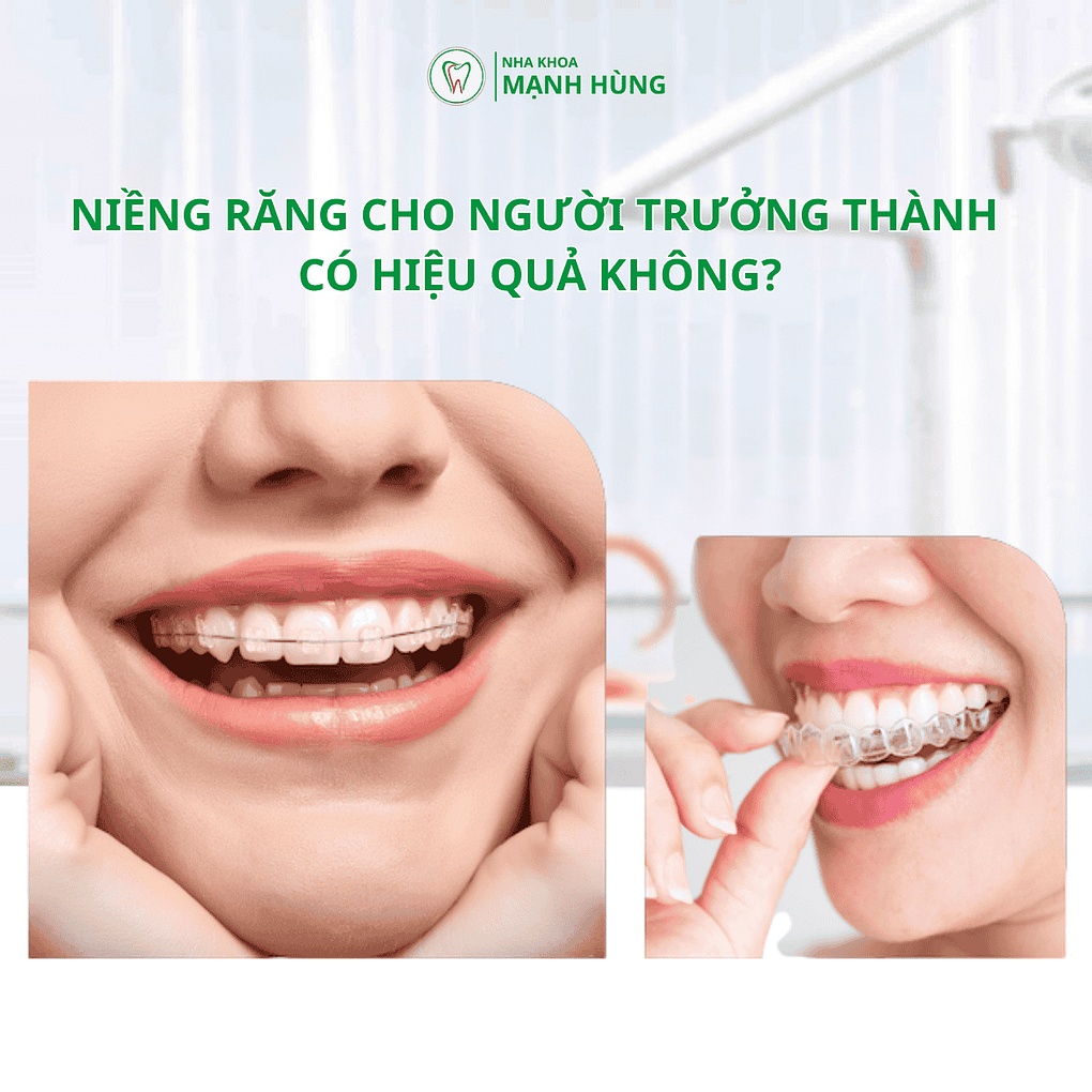 Niềng răng cho người trưởng thành: Có hiệu quả không? tại nha khoa Mạnh Hùng