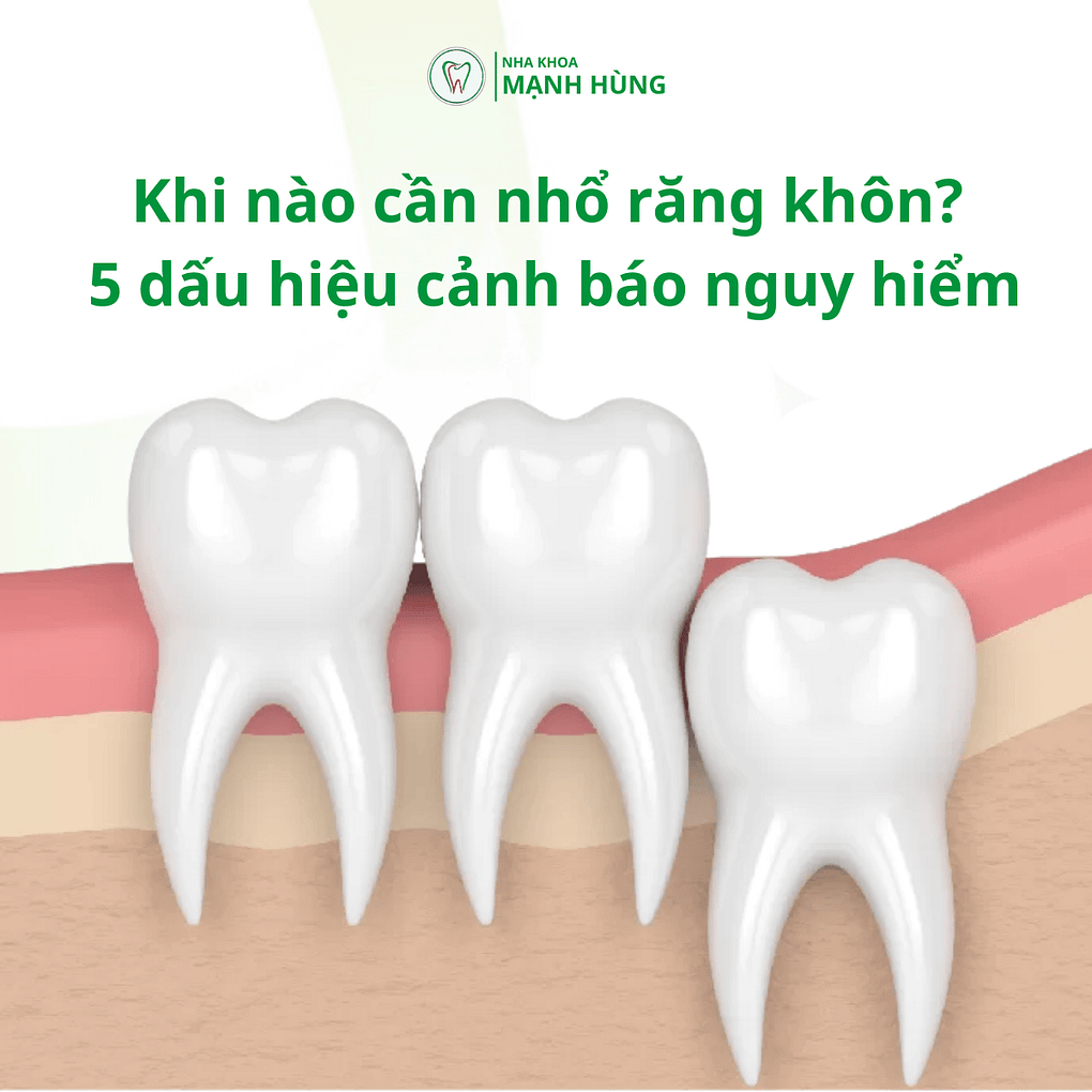 Khi nào cần nhổ răng khôn? 5 dấu hiệu cảnh báo nguy hiểm tại nha khoa Mạnh Hùng