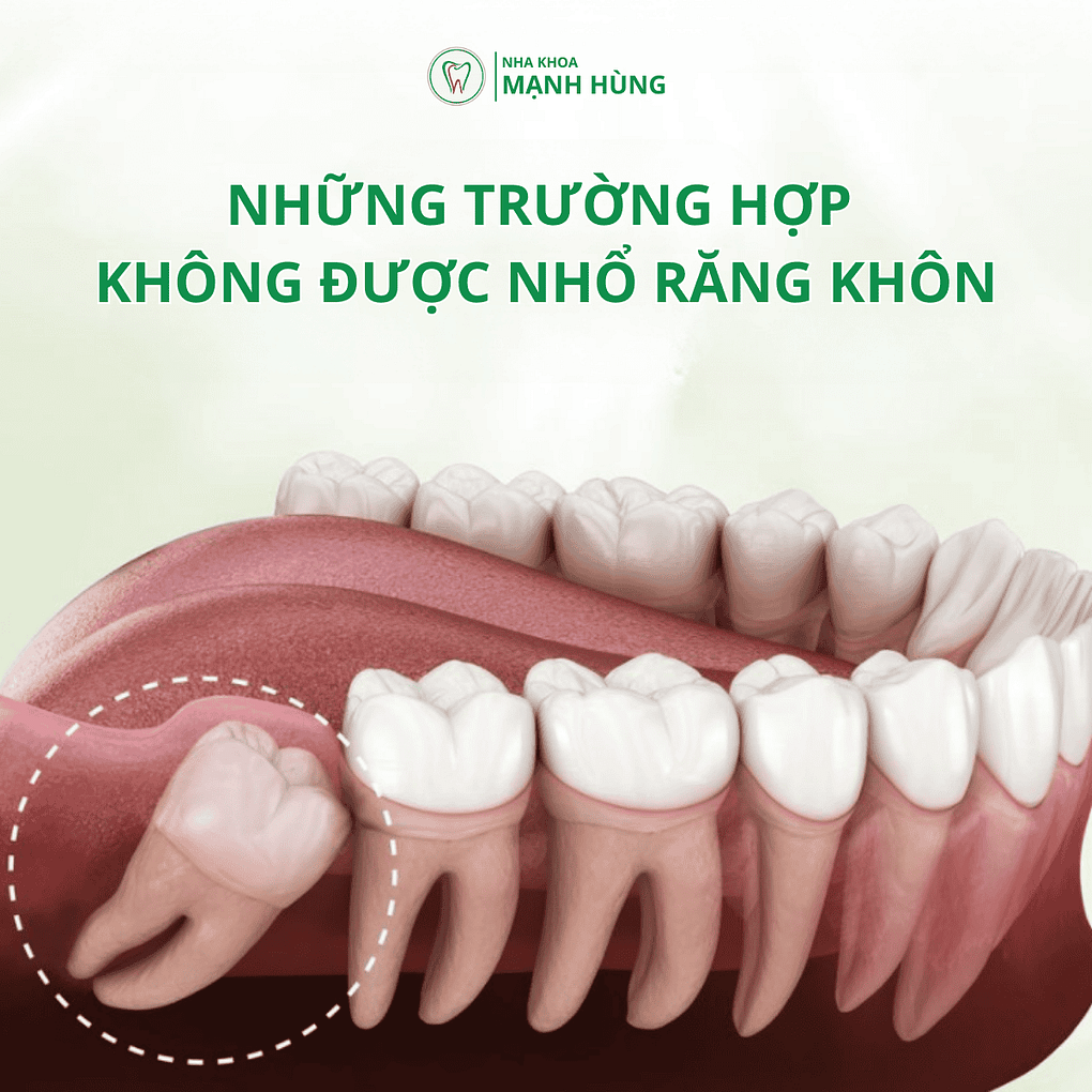Content FB (Những trường hợp không được nhổ răng khôn: Bác sĩ khuyến cáo cần lưu ý tại nha khoa Mạnh Hùng)