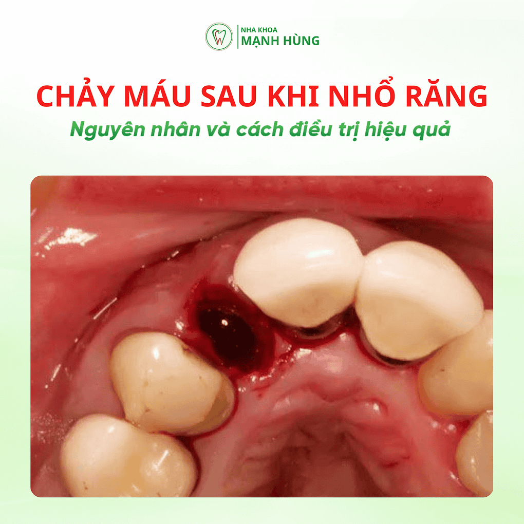 Chảy máu sau khi nhổ răng: Nguyên nhân và cách xử lý tại nha khoa Mạnh Hùng