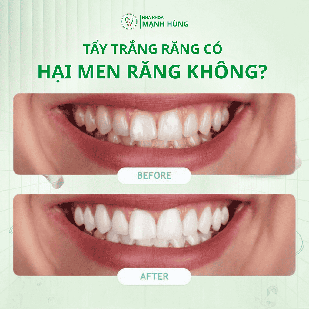 Tẩy trắng răng có hại men răng không? tại nha khoa Mạnh Hùng