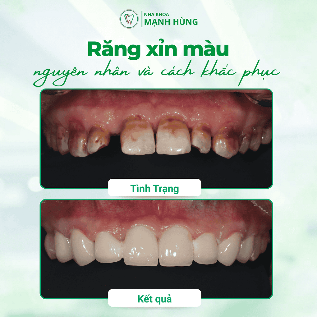Răng xỉn màu: Nguyên nhân và cách khắc phục hiệu quả