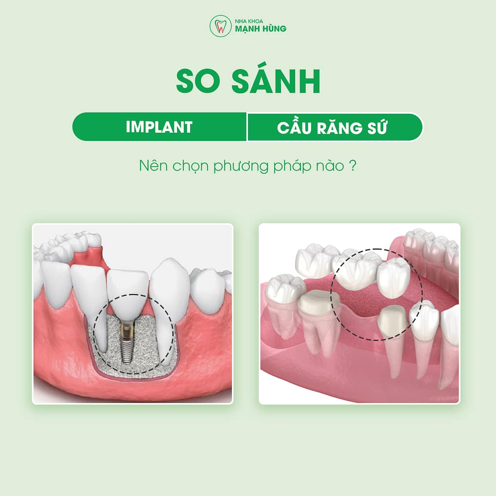 So sánh cấy ghép implant và cầu răng sứ