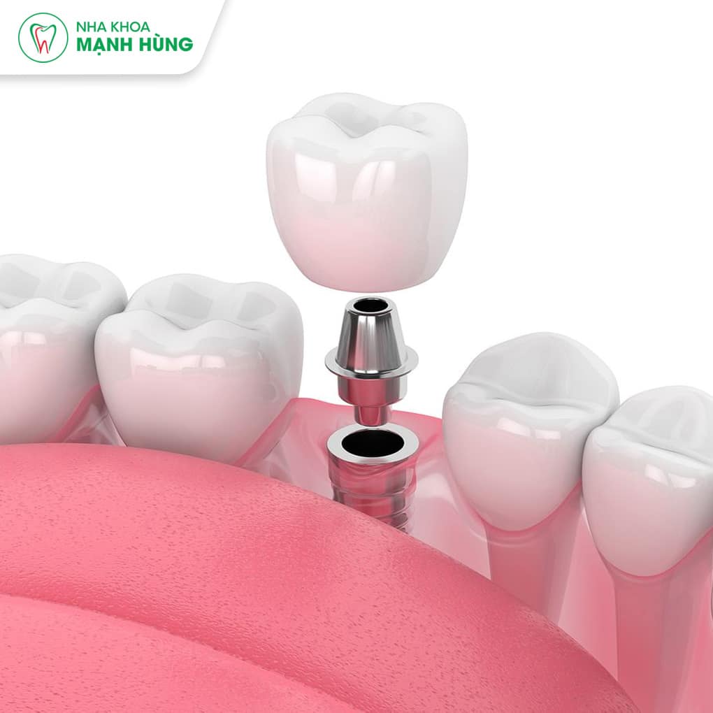 Trồng răng Implant