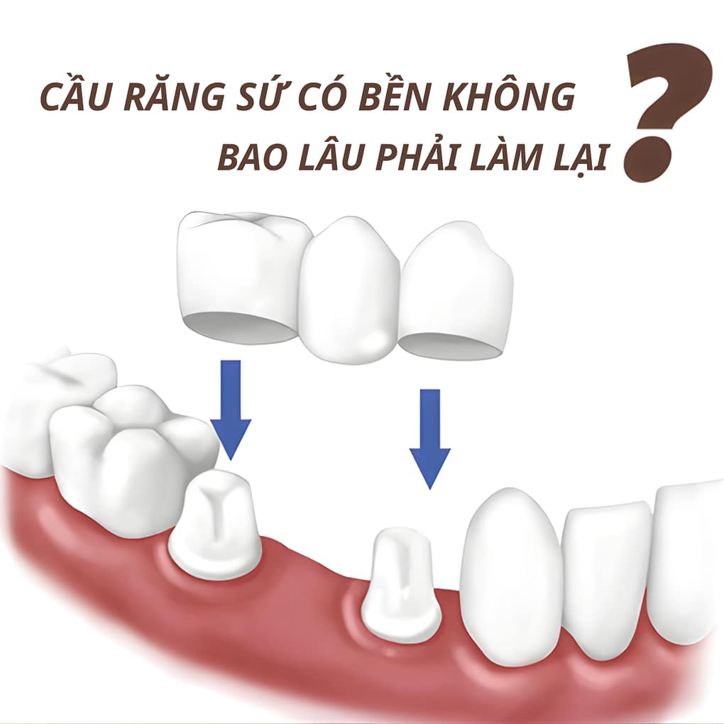 Cầu răng sứ có bền không? Bao lâu phải làm lại?
