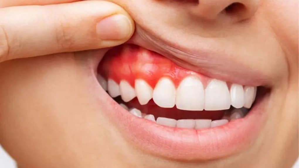 Đau nướu răng là bệnh gì?