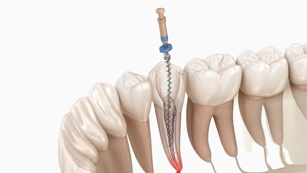 Điều trị tủy răng là gì?