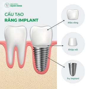 Cấu tạo của một chiếc răng Implant