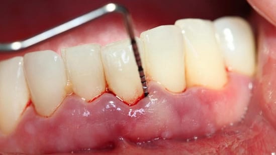 Bệnh nhân bị viêm nướu