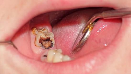 Điều trị tủy do sâu răng