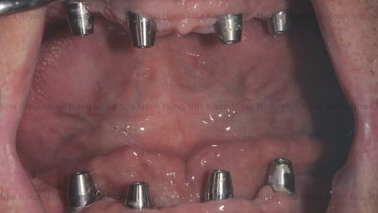 Cấy trụ Implant tại nha khoa Mạnh Hùng