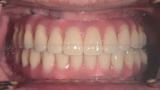 Lắp hàm răng sứ thẩm mỹ tại nha khoa Mạnh Hùng