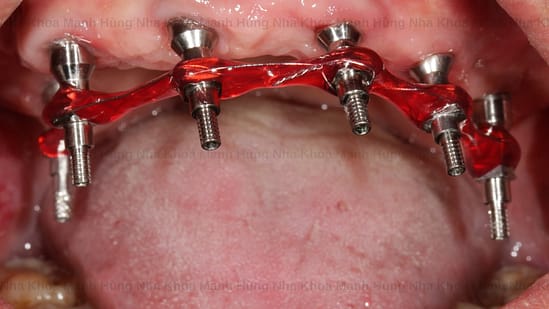 Phương pháp trồng răng All - on - 6 tại nha khoa Mạnh Hùng