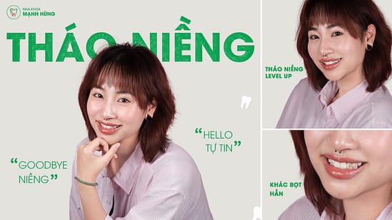 Giai đoạn trưởng thành (từ 18 tuổi trở lên): Vẫn có thể niềng răng hiệu quả