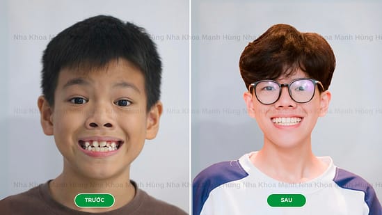 Giai đoạn trẻ em (6 – 11 tuổi): Can thiệp sớm khi cần thiết