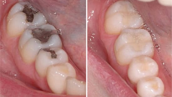 Hàn răng sâu tại nha khoa Mạnh Hùng