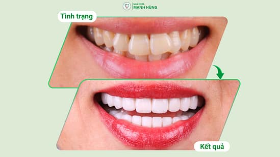 Răng sứ thẩm mỹ – Bí quyết cho nụ cười hoàn hảo tại Nha khoa Mạnh Hùng