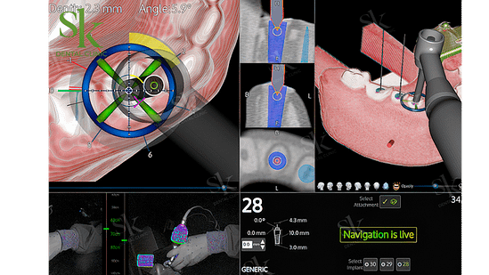 Robot định vị X-GUIDE hoạt động như thế nào trong cấy ghép