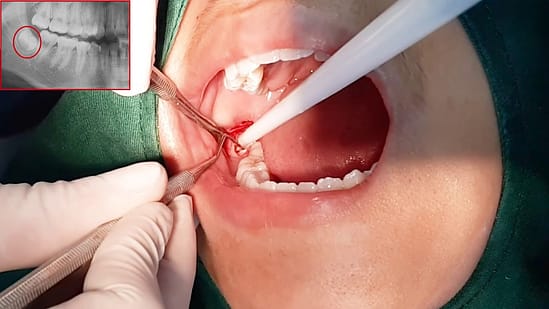 Những sai lầm khiến 90% người nhổ răng khôn “hối hận”