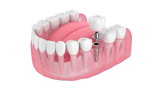 cấy ghép implant