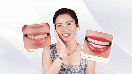 Bọc răng sứ
