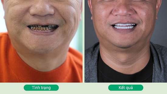 Khách hàng bọc răng sứ tại Nha khoa Mạnh Hùng