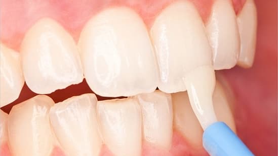 Fluoride cho trẻ là gì