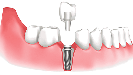 cấy ghép implant tại Nha khoa Mạnh Hùng