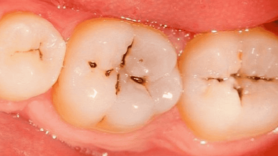 Dấu hiệu nhận biết sâu răng nhẹ