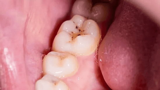 Bệnh nhân sâu răng hàm