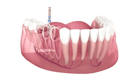 Quy trình chữa tủy răng chuẩn tại Nha khoa Mạnh Hùng