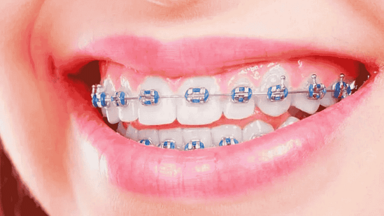 Niềng răng mắc cài tại Nha khoa Mạnh Hùng