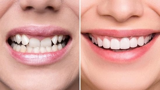 bọc răng sứ tại Nha Khoa Mạnh Hùng