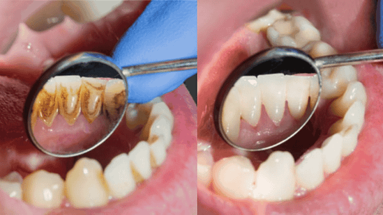 Bao lâu nên lấy cao răng định kỳ một lần