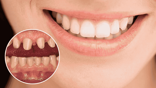 Bọc răng sứ được thực hiện như thế nào?