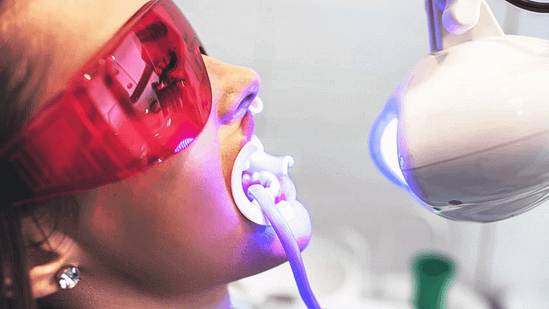 Tổng quan về tẩy trắng răng laser
