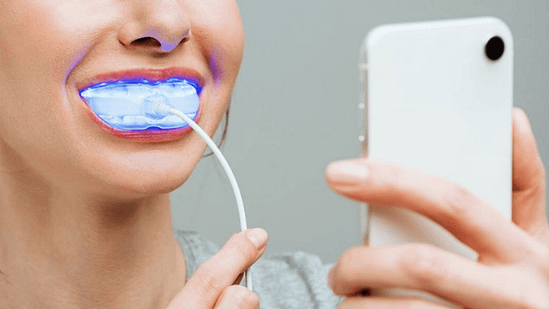 tẩy trắng răng tại nhà