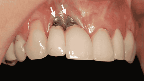 implant đào thải