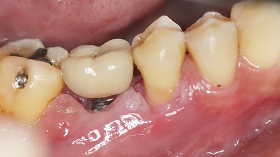 Cách xử lý implant bị đào thải